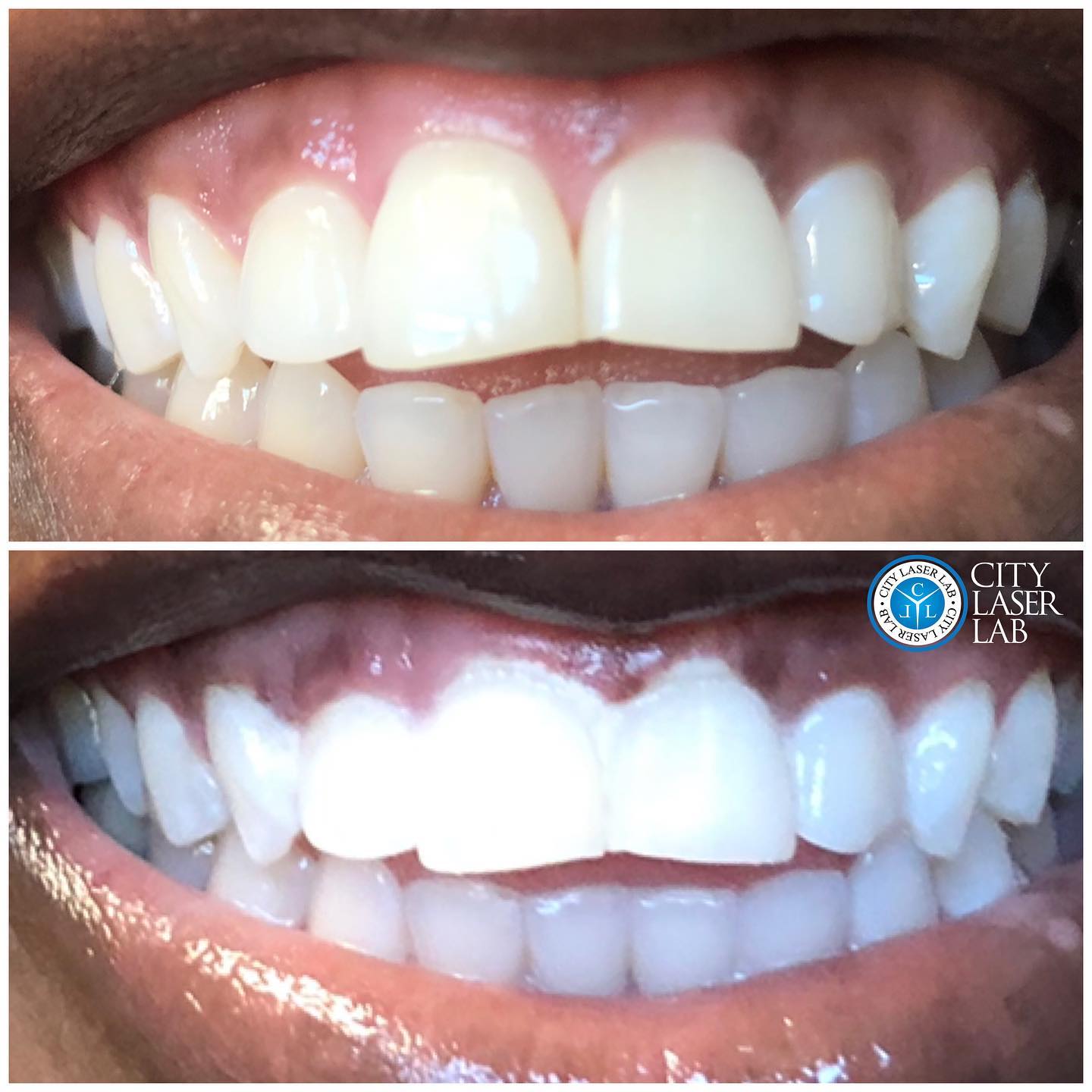 Before and after laser teeth whitening — real client 1
