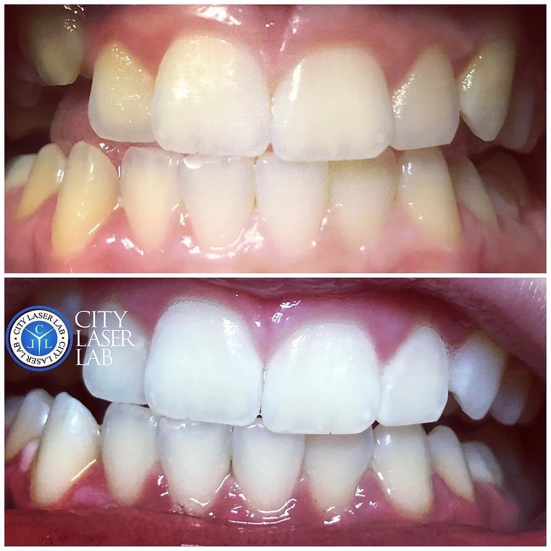 Before and after laser teeth whitening — real client 2