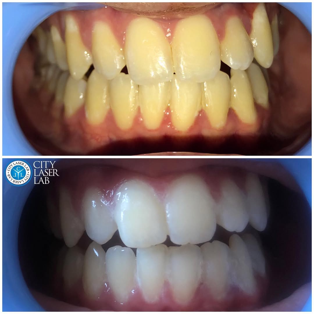 Before and after laser teeth whitening — real client 3