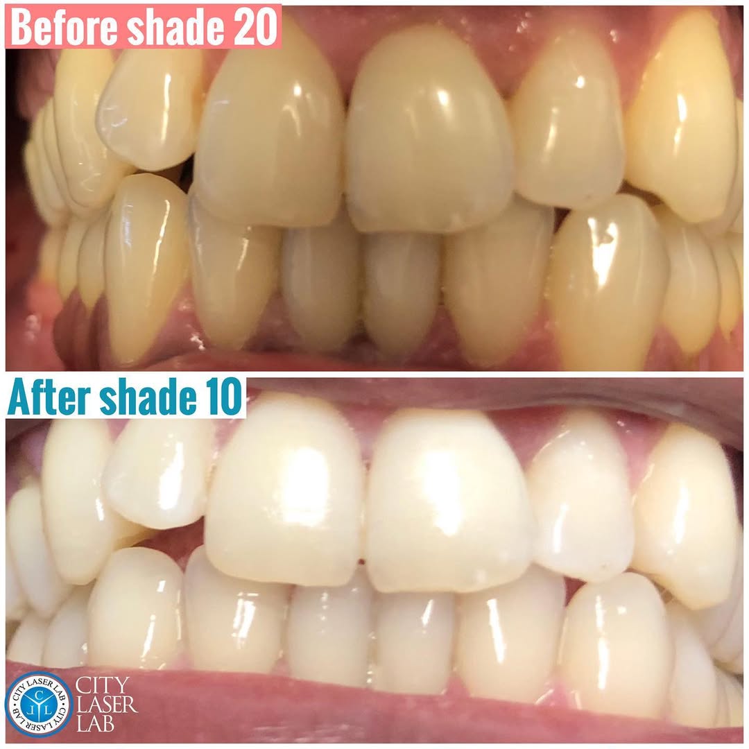 Before and after laser teeth whitening — real client 4 (shade 20 to 10)