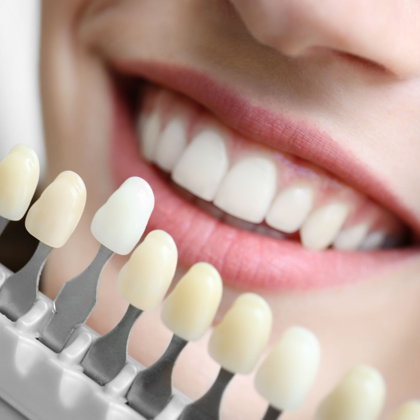 Bright smile after laser teeth whitening