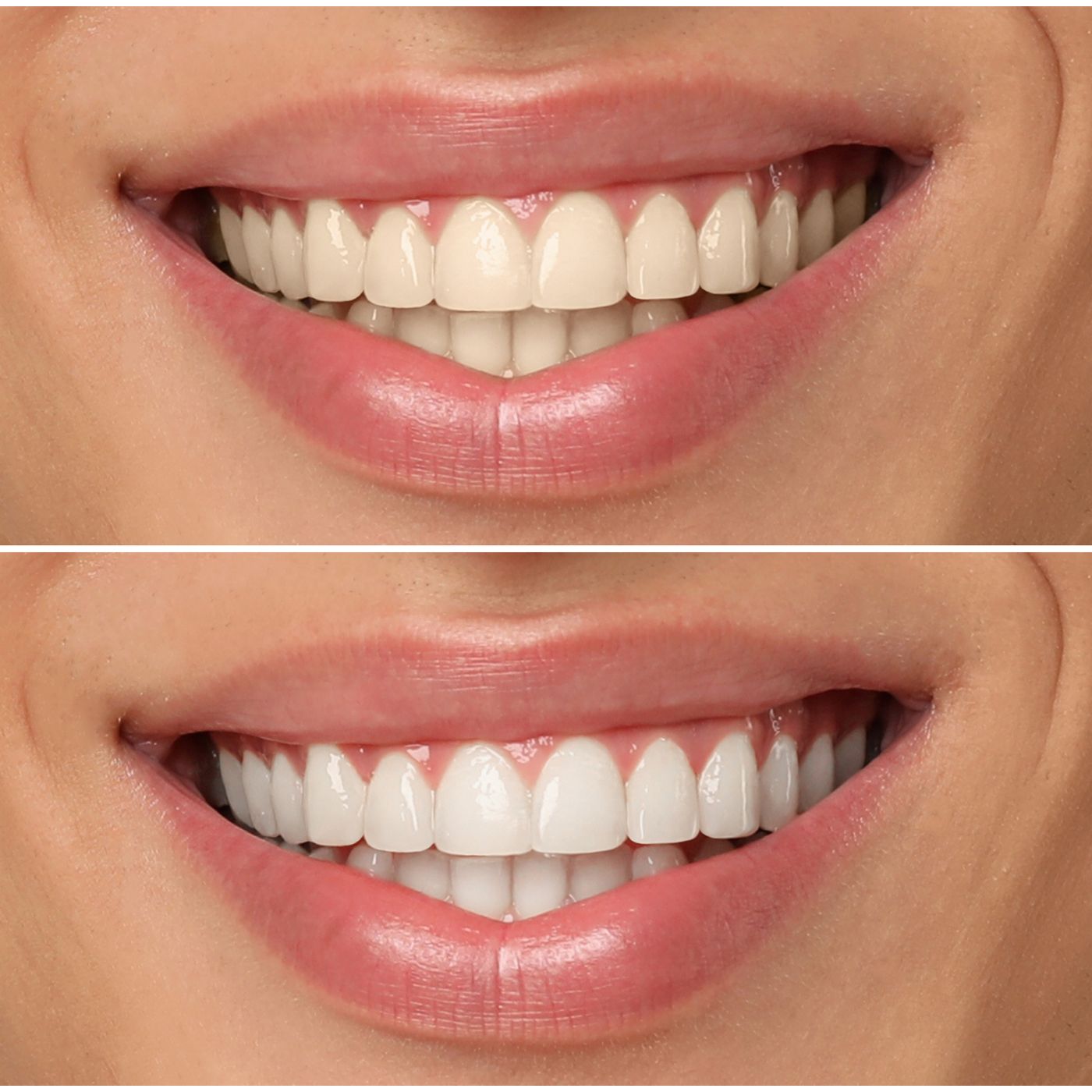 Bright smile after laser whitening