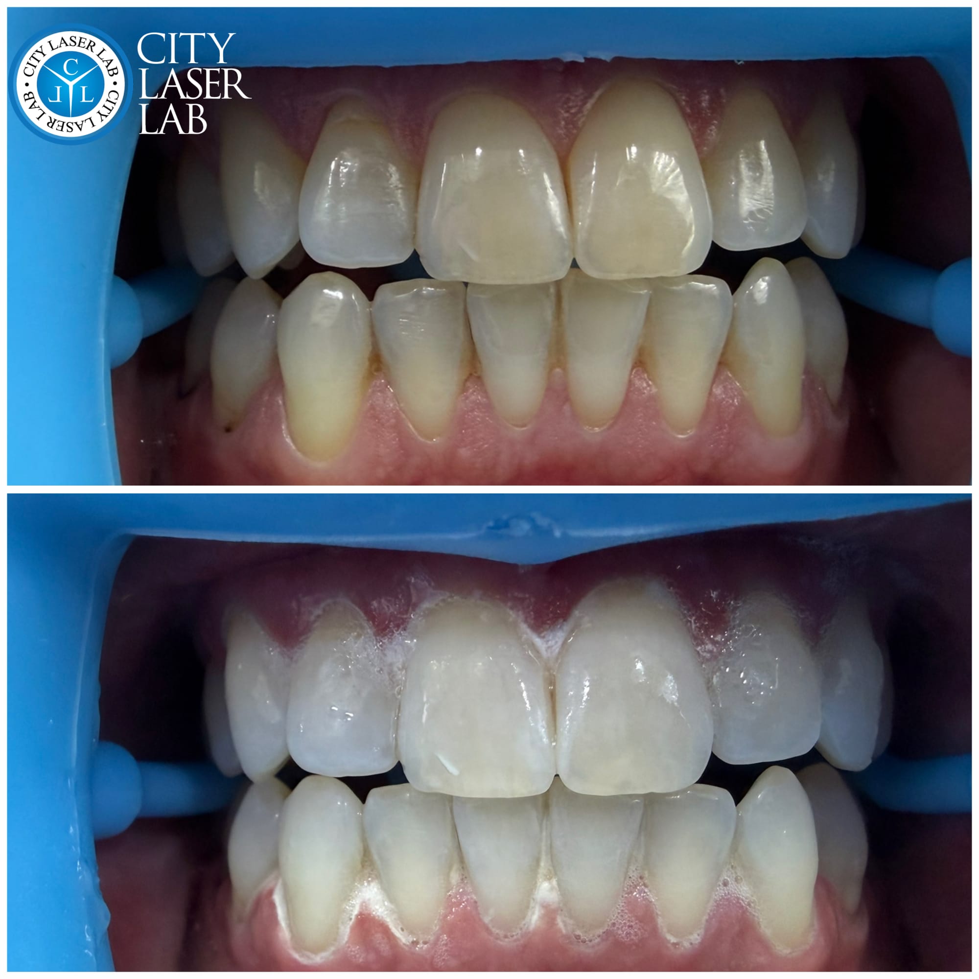 Before and after laser teeth whitening — real client 5